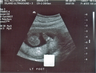 Ultrasound Jan 6, 2005 - Left Foot